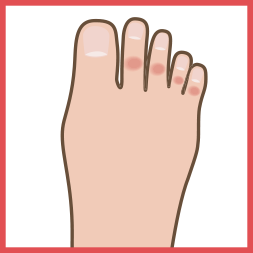 足指のタコ